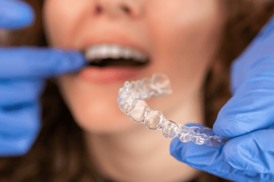 A person wearing blue gloves holds a clear dental aligner in front of someone’s open mouth, preparing to insert it.