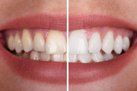 Close-up of a smile showing a side-by-side comparison of teeth before and after whitening — the left side is yellowed, and the right side is noticeably whiter and brighter.