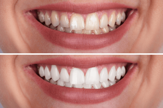 Close-up, side-by-side comparison of teeth before and after whitening. Top image shows yellowed teeth, the bottom shows bright, white teeth.